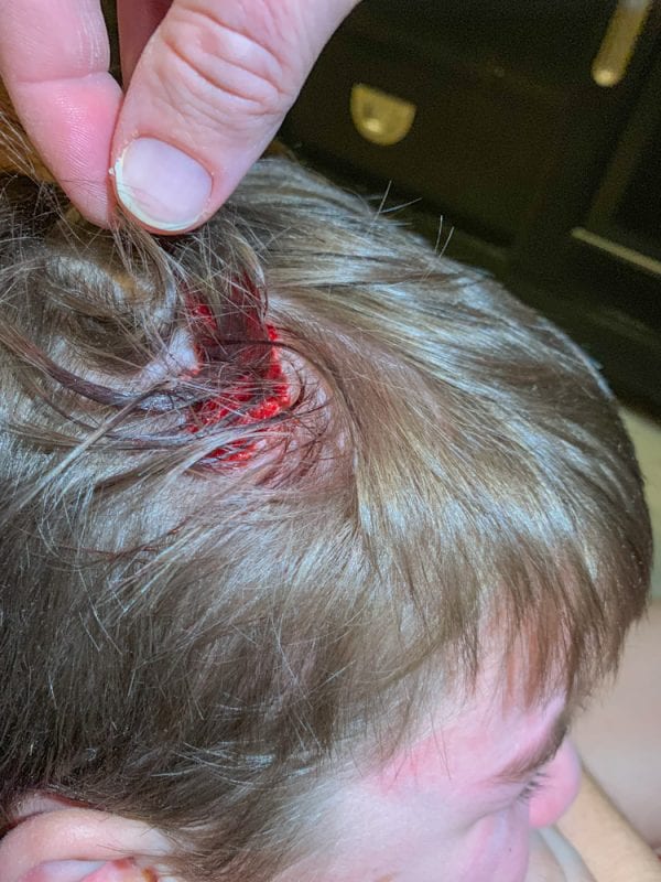 stitches in head